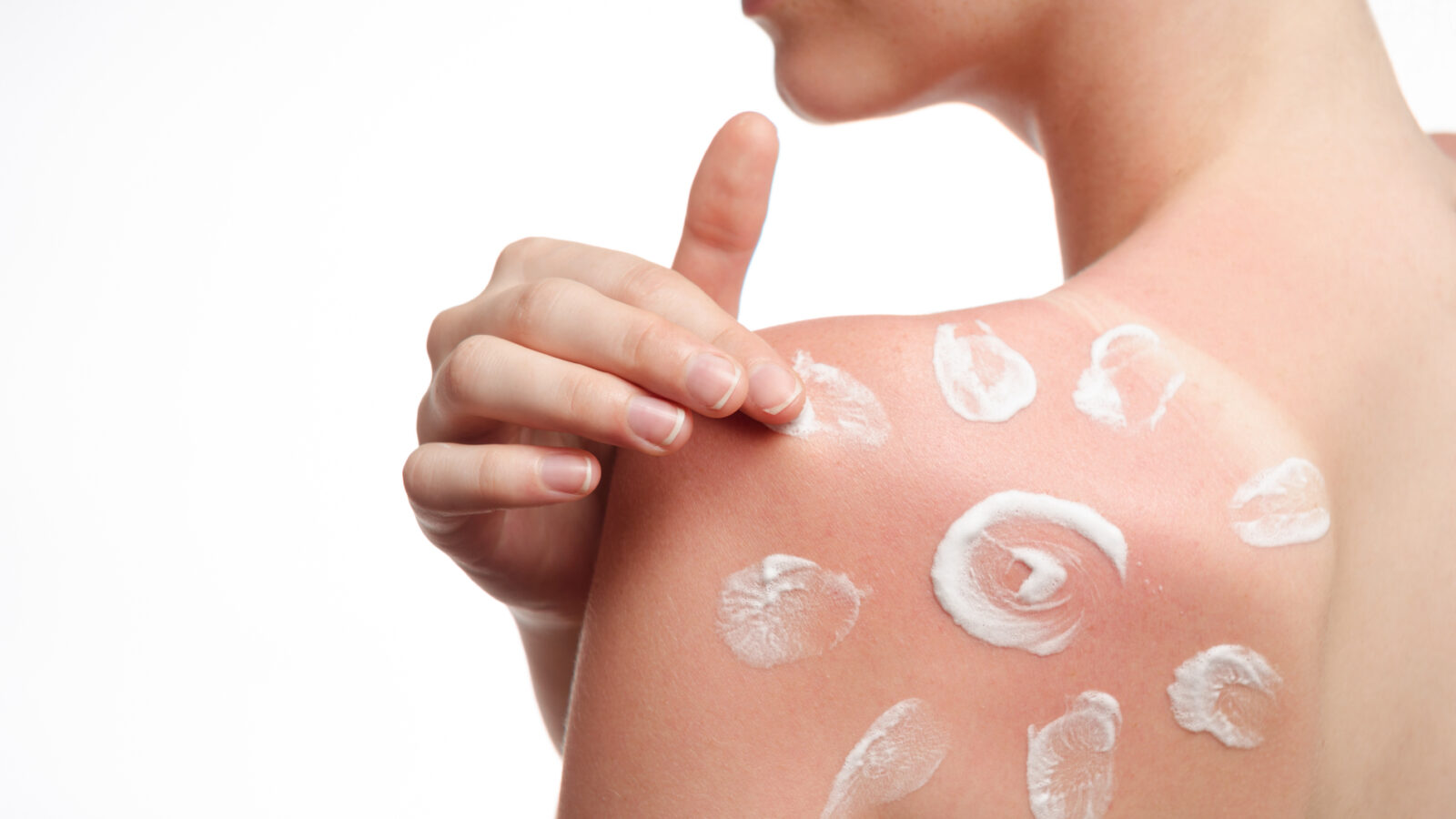 Sun Cream Skin Cancer | Lingen Davies